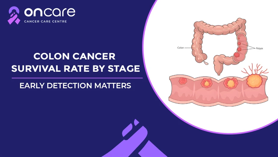 Colon Cancer Survival Rate by Stage Why Early Detection Saves Lives